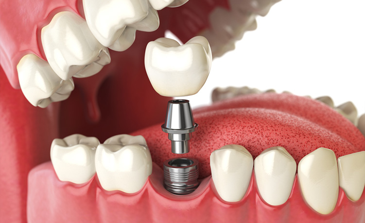 Dental Implants